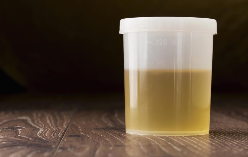 What Does My Cloudy Urine Means Health Changing