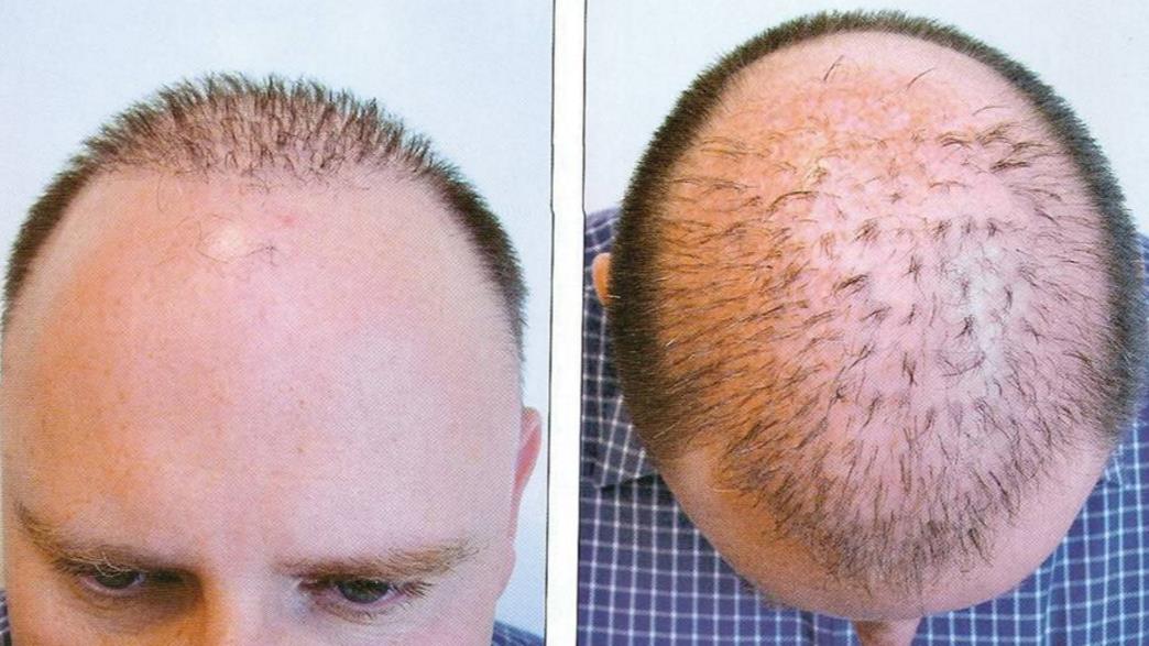 Prefect Can Your Body Reject A Hair Transplant for Rounded Face