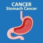 Stomach Cancer