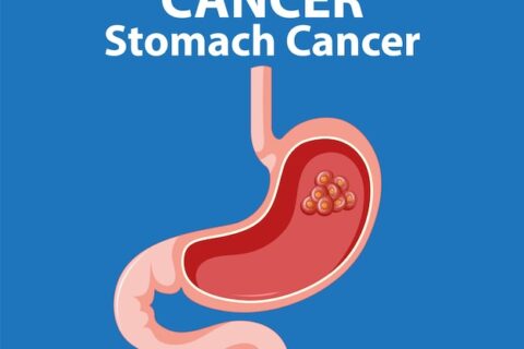 Resistant guideline in gastric adenocarcinoma is connected with remedial adequacy and further developed recuperation