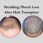 Hair Loss