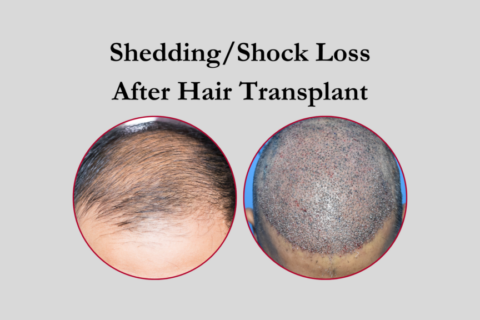 Why Patients Experience Hair Shedding After a Hair Transplant