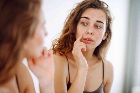 The intelligent approach to managing acne-prone skin
