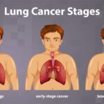 Lung Cancer