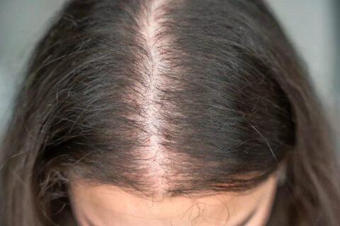 How to Diagnose Hair Loss and Its Causes
