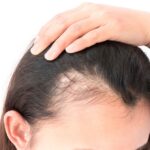 Hair Loss