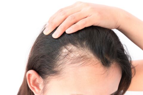 Hair Loss and Hard Water: The Causes, Effects, and Treatments