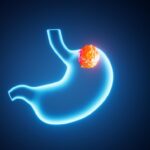 Stomach Cancer