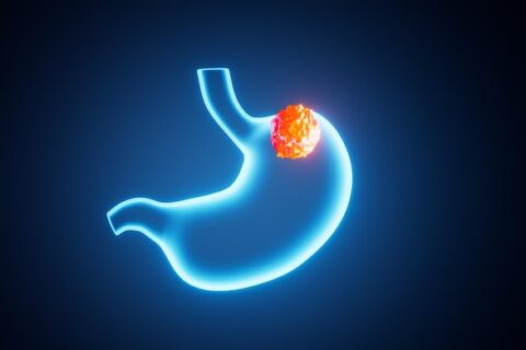 Silent Symptoms and Risk Factors for Stomach Cancer