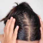 Hair Loss
