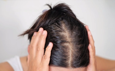 What is thinning hair? Expertly Explained Types, Causes, and Treatments