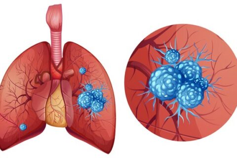 How you respond to various types of lung cancer