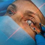 Cataract Surgery Options in 2026: What Every Patient Should Know Eyes