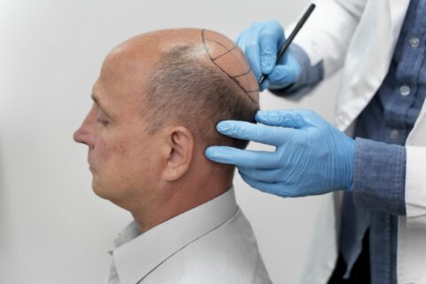 Who Should You See for a Hair Transplant? A Patient’s Guide to Choosing Wisely