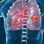 FDA Grants Accelerated Approval to Zongertinib for HER2-Mutated NSCLC Lung Cancer