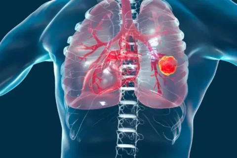 FDA Grants Accelerated Approval to Zongertinib for HER2-Mutated NSCLC