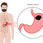 Stomach Cancer