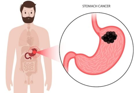 CANCER OF THE TROPH What’s the stomach?