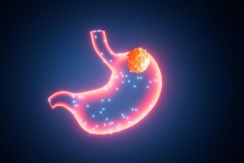 Early Warning Signs Of Stomach Cancer