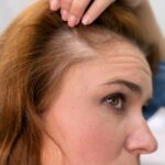 Prevent hair loss: Insights from trichologists on dietary choices for healthier hair
