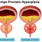 Conventional imaging missed the spread of prostate cancer Prostrate Cancer