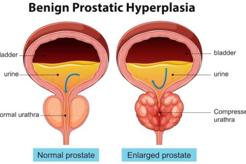 Conventional imaging missed the spread of prostate cancer