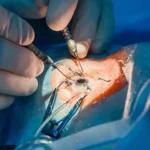 Cataract Surgery Cost in Kolkata: What Shapes the Price and How Insurance and Self-Pay Work